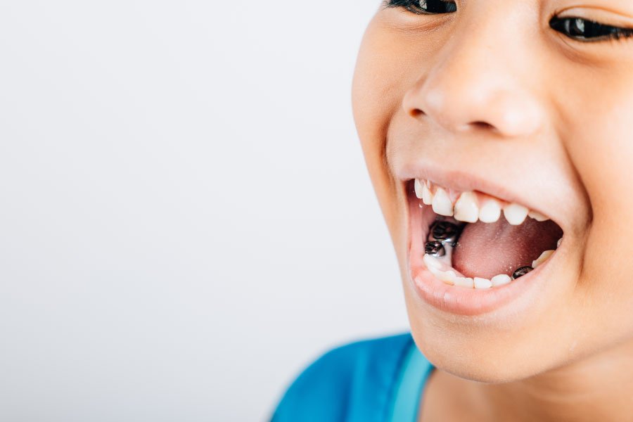 Bellevue Hall Dental Crowns