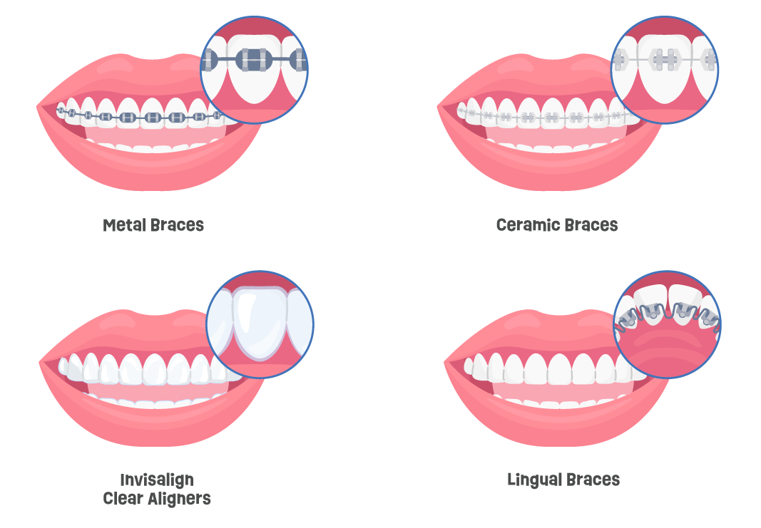 Types of Braces
